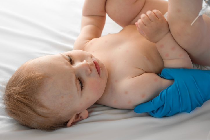 Bebé infetado com sarampo, uma doença visualmente semelhante à roséola infantil